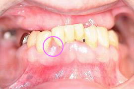 歯周内科治療の症例